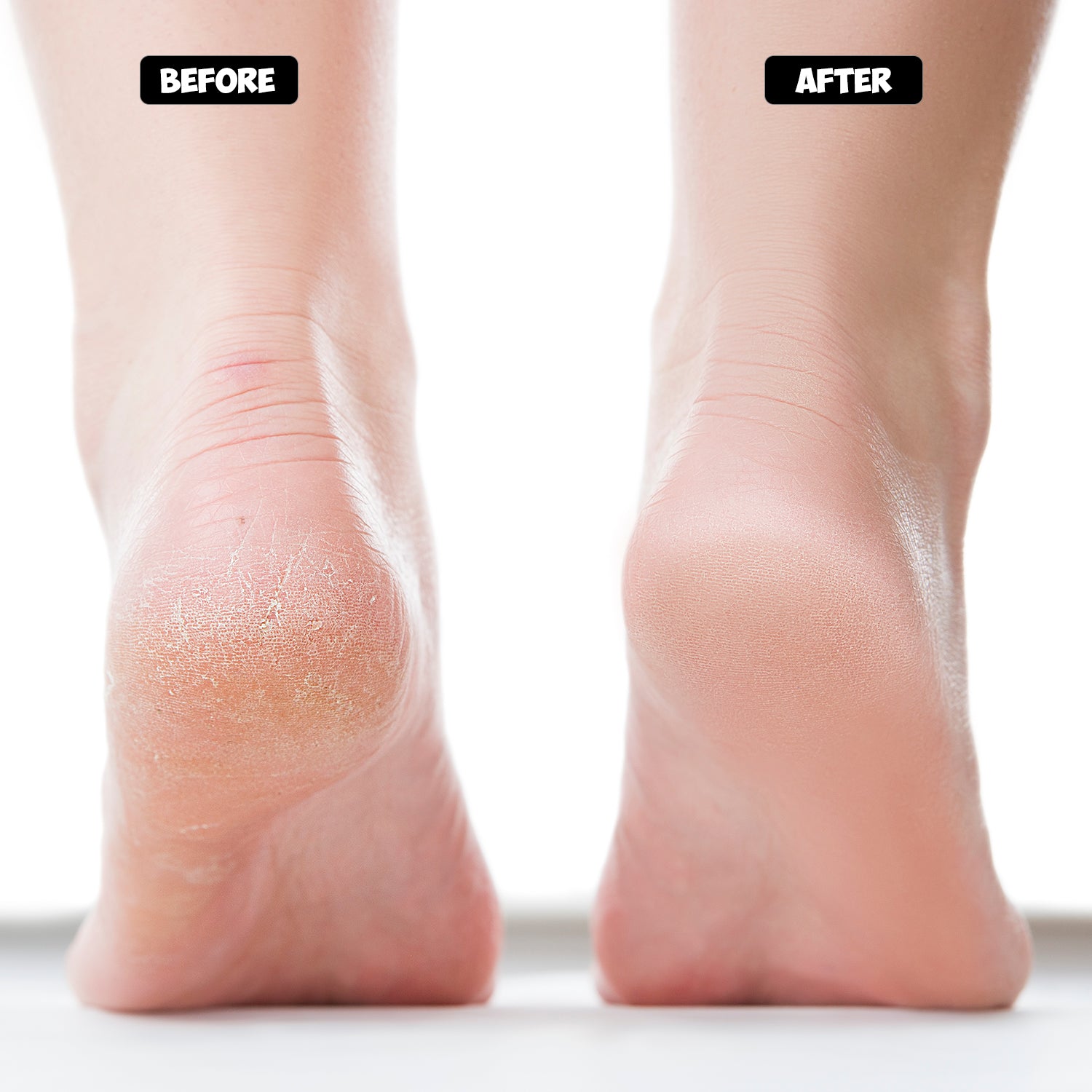 Cracked Heel Treatment the Foot Cream Should Be Applied Regularly. Rub and  Massage the Heels for the Cream Stock Photo - Image of healthy, human:  234571038